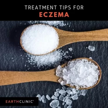 Natural Remedies for Eczema